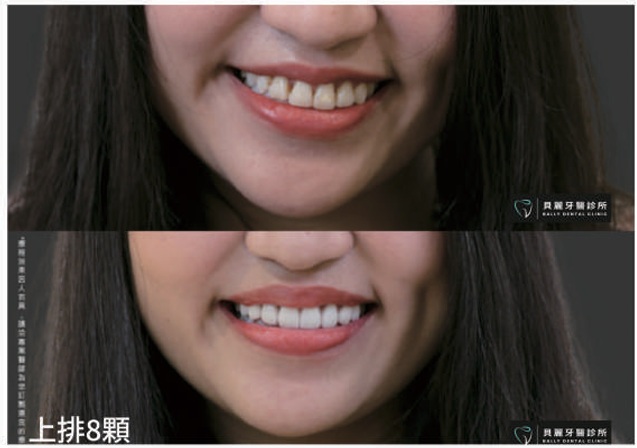 全瓷貼片案例-上排8顆牙齒